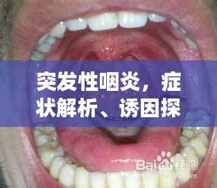 突发性咽炎,症状解析、诱因探究及应对良方